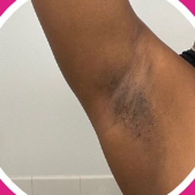 Dark marks: Underarms