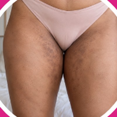 Dark marks: Inner thighs