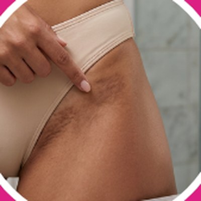 Dark marks: Bikini line