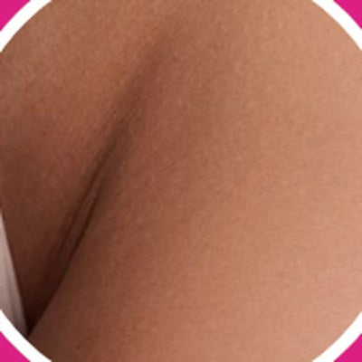 Dark marks: Vulva area (outer skin)