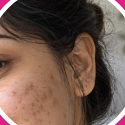 Dark marks: Face (not near eyes)