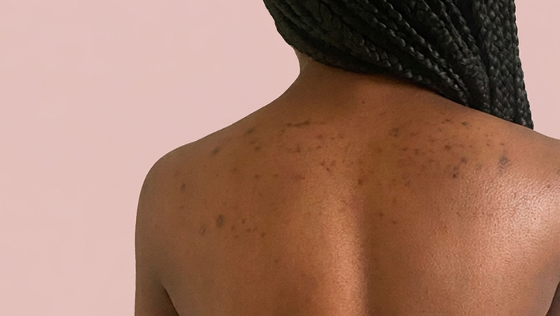 Skin tone in the area starts to look more even. Texture feels comfortable, not tight.